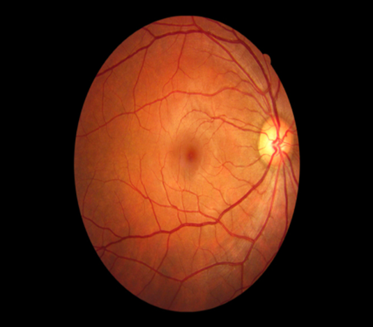 Vision Screening Of Preschool Children In Mobile Clinics In Iowa Vision Screening Of Preschool Children In Mobile Clinics In Iowa